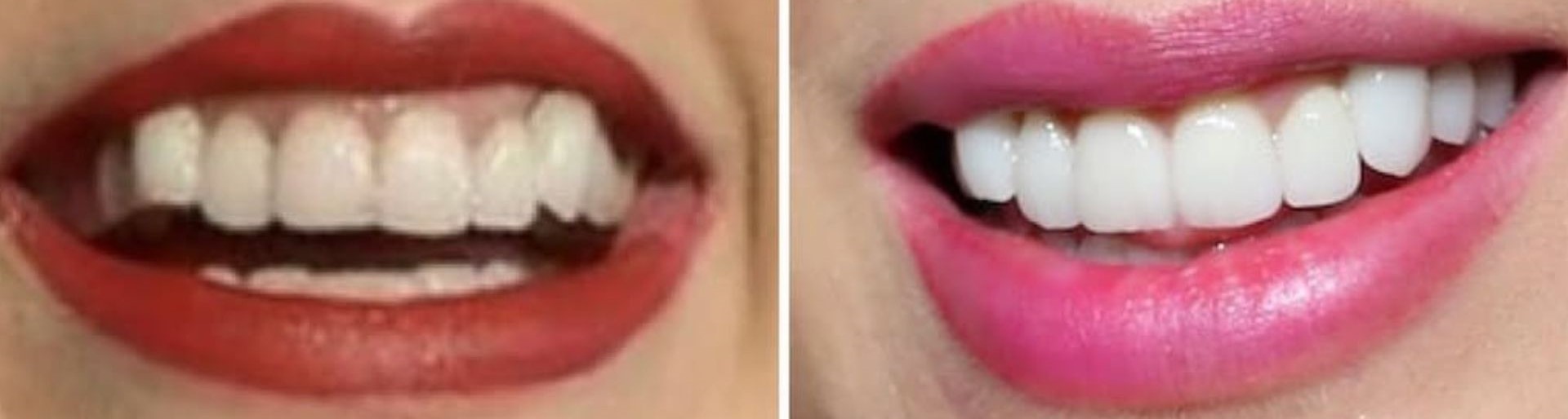 Taylor Swift before dental work